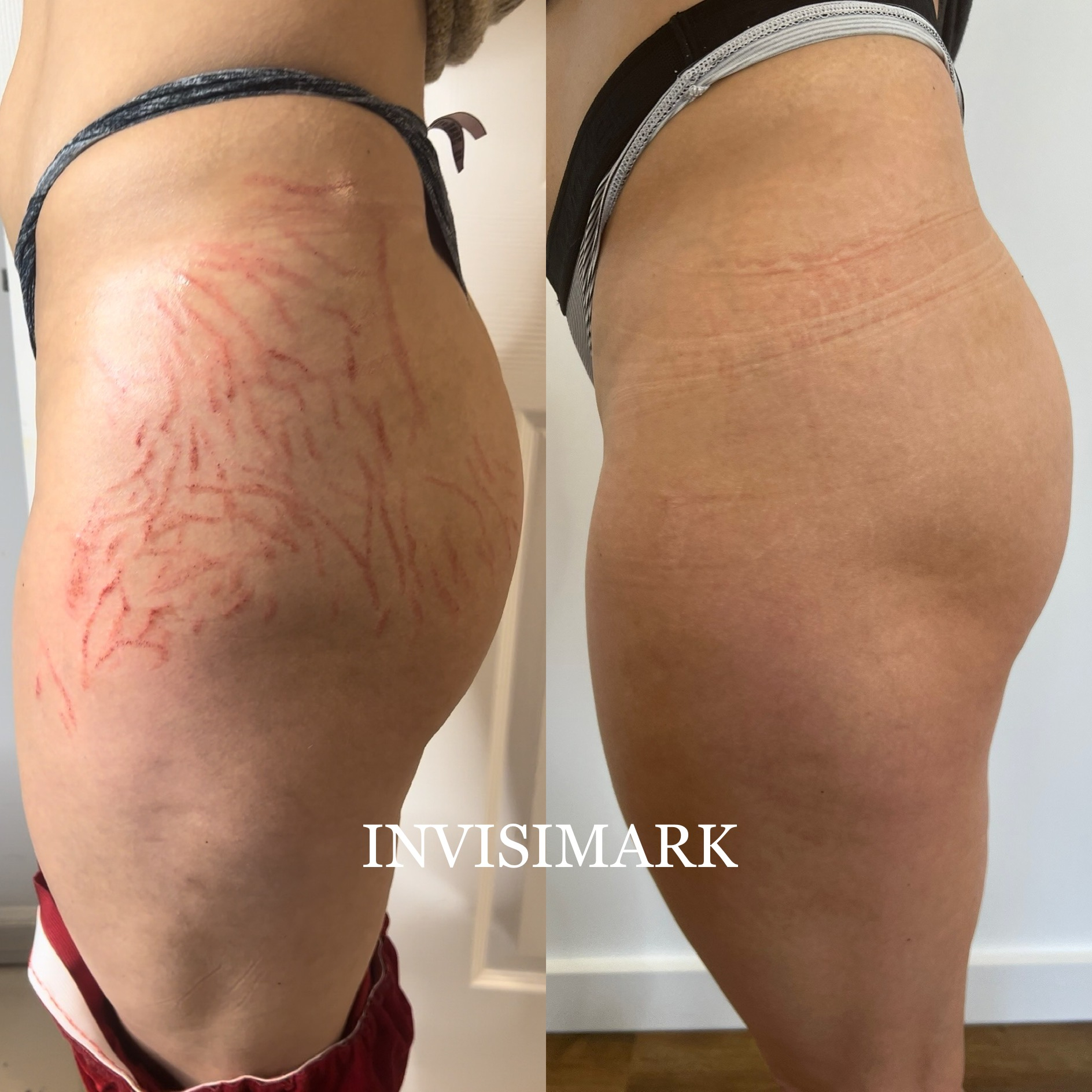 Inkless Stretch Marks Training Course